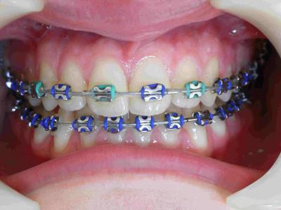 traitement orthodontique marseille 13005