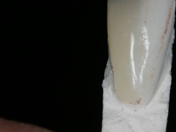 implant dentaire marseille 5