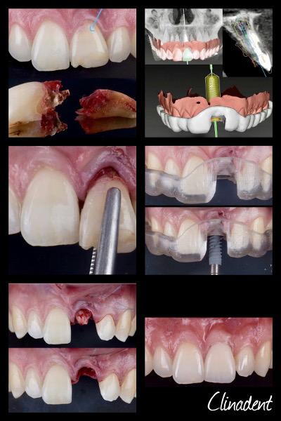 Implants dentaires Marseille 13005