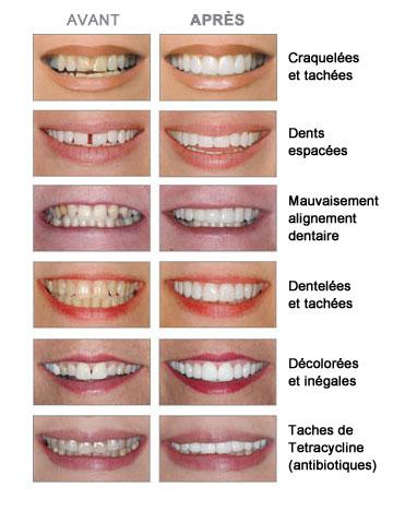 Dyschromies dentaires Marseille