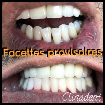 Réalisation de facettes dentaires au centre Clinadent Marseille 13005