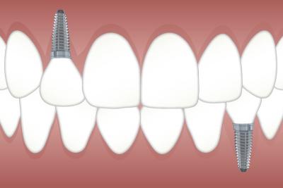implant dentaire marseille 5