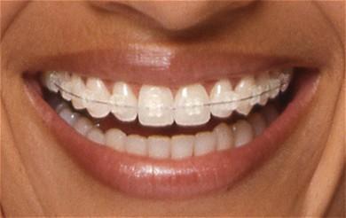 Orthodontie Marseille 5